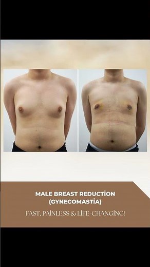 Male Breast Reduction (Gynecomastia): Fast, Painless & Life-Changing! 💪