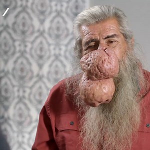 Roger visits Dr Lee for a life-changing rhinophyma removal 🤩 #DrPimplePopper | Love Medical