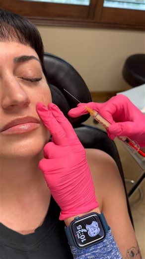 Why we use PRF injection part 3: PRF gel is a 100% natural biostimulating injectable that utilizes the body’s natural proteins and growth factors to improve skin tone and texture while treating deep tear troughs, lines and wrinkles, volume loss, and more. Our nurses draw your blood and separate its components through centrifugation. This process extracts and isolates the platelets, growth factors, and stem cells into an albumin matrix.draws your blood and separates its components through centrif