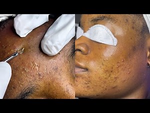 From Breakouts to Glow-up | Intense Acne Extraction Facial