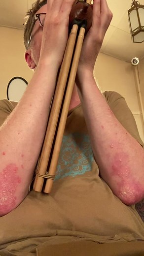 Dealing with Psoriasis on the Elbows: Ways to Manage Elbow Pain