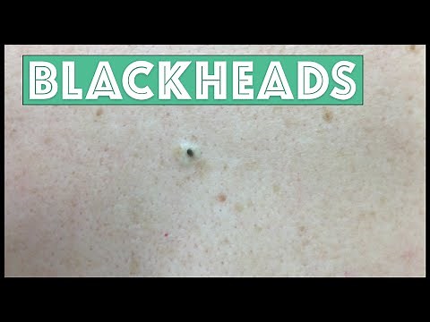 Just Blackhead Extractions!!