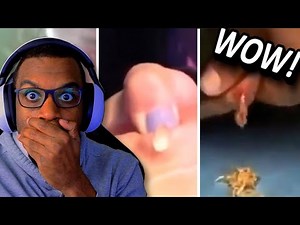 CYST POP SQUIRTED ALL OVER HER FACE?!