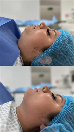 1.7K views | Chin Lipo (Jaw contouring) for 999 USD ✅ Outpatient procedure✅ Board Certified Plastic Surgeon ✅ Fully equipped Hospital❗️Please send us a private message or email to: balticsurgery@gmail.com for more details.••••#BalticSurgeryTijuana #PlasticSurgeryTijuana #ChinLipo | Baltic Surgery Tijuana - Bariatrics & Plastics | Facebook