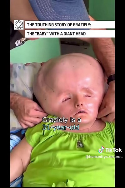 World's Biggest Head: Record-Breaking Size Revealed