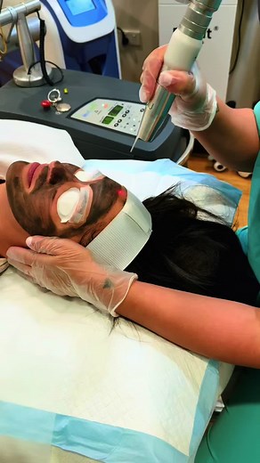 Carbon Facials: Transform Your Skin with Laser Treatments