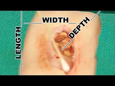 Wound Measurement- Understand Wound Care