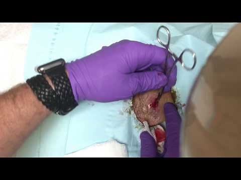 Re-TREATED ABSCESS! STILL INFECTED. INCISION / DRAINAGE AND PACKING