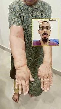 What is Lymphedema and how it is treated? #shortsfeed #lymphedema #lymphedemaawareness