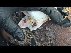 Anthony Ochango's first jigger dig - see long video @ riseupsociety.net & ruskenya.org