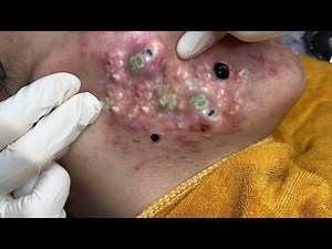 𝑪𝒚𝒔𝒕𝒊𝒄 𝑨𝒄𝒏𝒆 𝑹𝒆𝒎𝒐𝒗𝒂𝒍 & 𝑰𝒏𝒇𝒍𝒂𝒎𝒎𝒂𝒕𝒐𝒓𝒚 𝑨𝒄𝒏𝒆 #825588