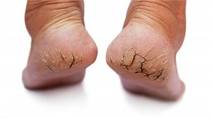 Crack Heel: सरसों के तेल से बनाएं मास्क, फटी एड़ियों से मिल जाएगी राहत