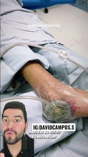 DIABETIC FOOT HEALING WITH VAC THERAPY