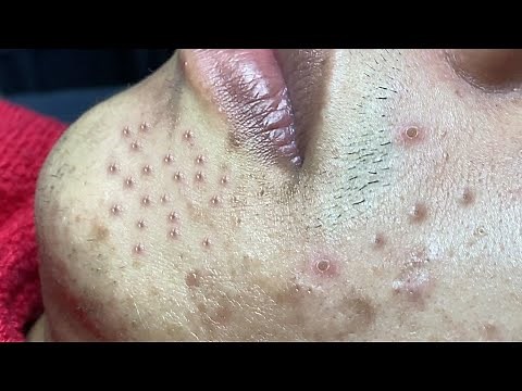 Satisfying video with Hien Nguyen Spa Beauty #014
