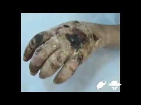 Krokodil (crocodil): The drug that eats junkies