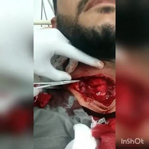 Neck Incision Surgery