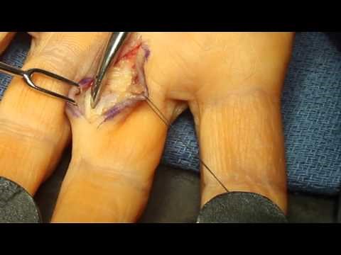 Live Surgery: Ganglion Cyst: Flexor Tendon Sheath (Finger)