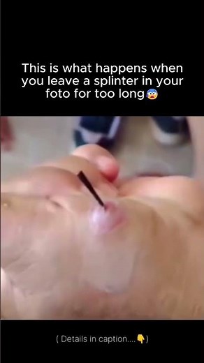 When you leave a splinter in for too long...😰 #gross #healthtips