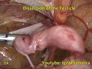 Laparoscopic Orchiectomy - Cryptorchidism on 1 year baby