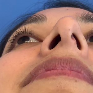 How to correct a nasal valve collapse.