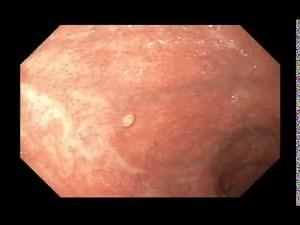Stomach, Benign Findings, Submucosal Lesion • Video • MEDtube.net