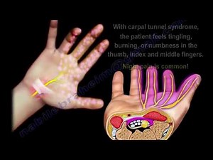 understanding Carpal Tunnel Syndrome in seconds - Everything You Need To Know - Dr. Nabil Ebraheim
