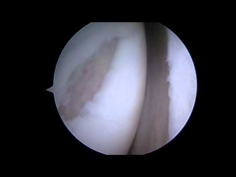 Arthroscopic Microfracture of the Knee Explained by a Phoenix Orthopedic