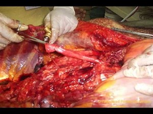 Tecnicas para Embalsamar Cadaveres - embalming techniques (Cadaveres con Autopsia)