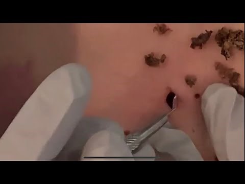 Top Biggest Blackhead on the world #21