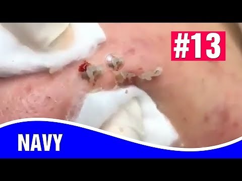 AMAZING! Blackheads Removal - How To Remove Blackheads | NAVY #13