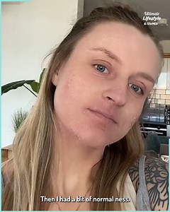 148K views · 186 reactions | My skin condition is so painful and I’ve been living with it for over 2 years  | Ultimate | Facebook