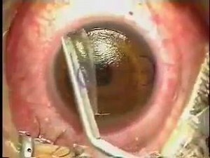 1.5K views · 28 reactions | "Get it right the first time" LASIK EYE...