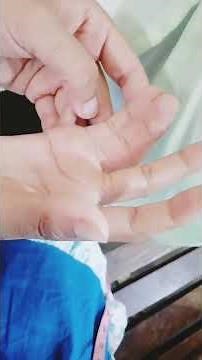 Polydactyly and Syndactyly...