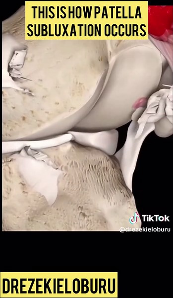 Patella Dislocation: Insights from an Orthopedic Surgeon