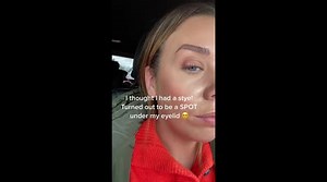PIMPLE POPPER: Woman shares shocking clip popping spot under eye – leaving social media users queasy