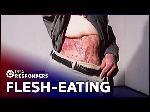 The Flesh-Eating Illness Causing Horrific Destruction | Diagnosis Unknown | Real Responders