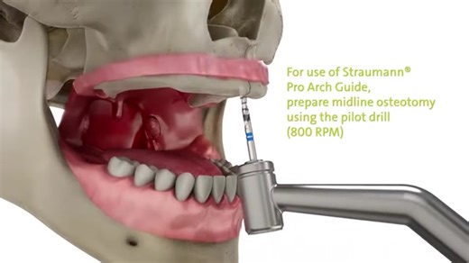 Straumann PRO Arch® - Restaurarea completa a danturii cu 4 sau 6 implanturi Straumann si dinti ficsi in 24 ore! Avantajele implanturilor dentare Straumann PRO Arch®: ✅Utilizarea unui numar redus de implanturi: de regula 4 implamturi la mandibula si 6 implanturi la maxilar ✅Implanturile Straumann sunt fabricate dintr-un aliaj extrem de rezistent de titan cu adaos de dioxid de zirconiu – Roxolid. Aceasta caracteristica permite utilizarea de implanturi cu dimensiuni mai mici, evitandu-se astfel pro
