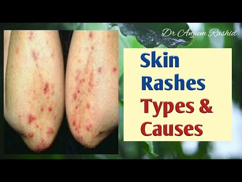 Skin Rashes Types, Causes and Identification