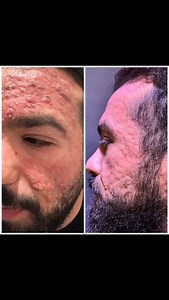 “Acne conglobata can be tough, but the right treatment makes all the difference! 💡 Early intervention is key—don’t wait to seek expert care. 🔬✨ #ClearSkinJourney #AcneTreatment #Dermatology” #klinik29 #always 29 | dr.hossamelenany