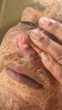 ****NEW**** 2023******CYSTIC ACNE REMOVAL