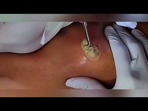 Extreme Cyst Popping – Satisfying Sebaceous Extraction Up Close!