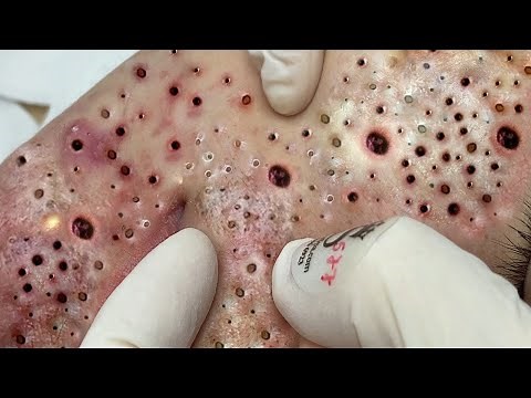 角栓 ブラックヘッド 角栓除去 ニキビ芯出し | ーニキビ #にきび治療 #BlackHeads #Whiteheads #Acnes #Dr Chong Clinic