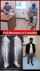 Tibia bone proximal fracture full Recovery #fracturetreatment #fracturerecovery #tibiafracture