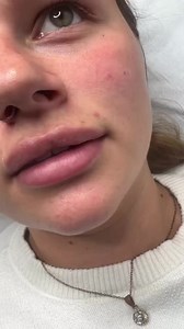 Lip Blush What is lip blushing? Lip blushing is a semi-permanent tattoo that can enhance the color and shape of your lips and give the impression of more fullness. This is done by depositing color ink into your lips and along your lip line to improve the overall look. The color is subtle to give natural-looking results. | Flawless Cosmetic | Facebook