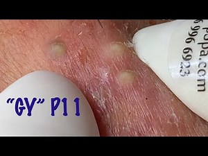 Relax Every Day With nasa Spa | acne skin blackheads #15