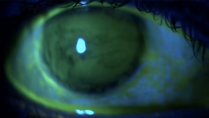 Fluorescein: An ode to a humble stain - Eyetube