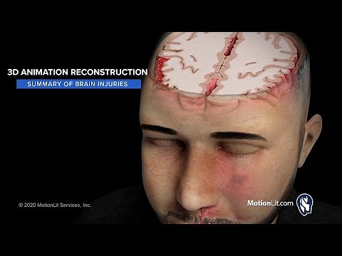 Head Trauma Animation Depicts Scope Of Brain Injuries Ensued After Bar Fight