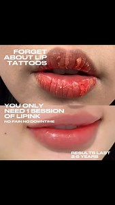 3K views | Planning to do lip embroidery? Think twice! Think thrice! Now we can restore your original lip shade of pink without needles, pain and downtime! #onlypink #lipink #pinklips #pink #liptattoo #lipembroidery #beauty #Onlyaestheticssg | ONLY Aesthetics | Facebook