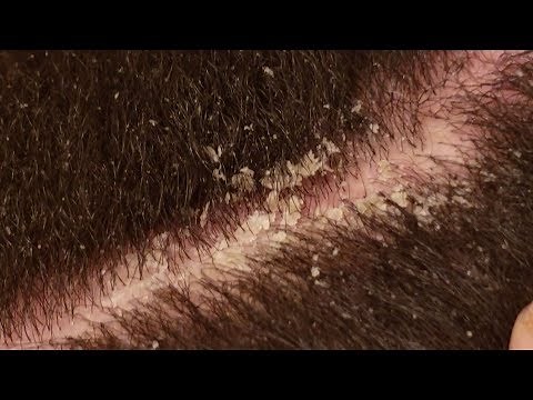 Dandruff Scratching ASMR Scalp Covered in Thick Flakes Dandruff Removal V.3