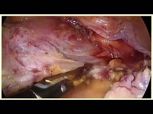 Total Laparoscopic Hysterectomy | Dr Amir Ansari